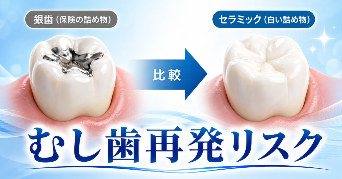 銀歯はむし歯になる？セラミックはなりにくい？　再発リスクを紹介