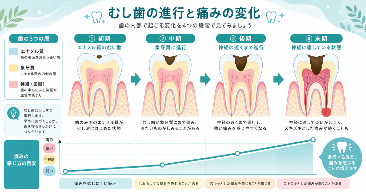 痛くないむし歯が進む理由とは？多忙な方が知るべき受診の目安