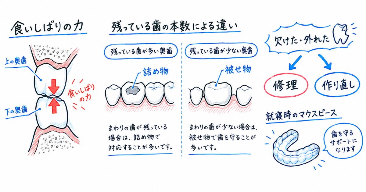 食いしばりと残った歯の量で、欠けにくさの考え方は変わる