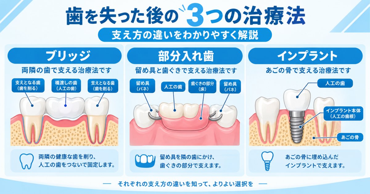 歯を失った後の治療選択肢3つの仕組みと保険適用の条件